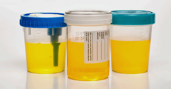 Des tests d'urine: types et les résultats de décodage