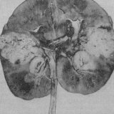 Tuberkulos av njure och urinvägar