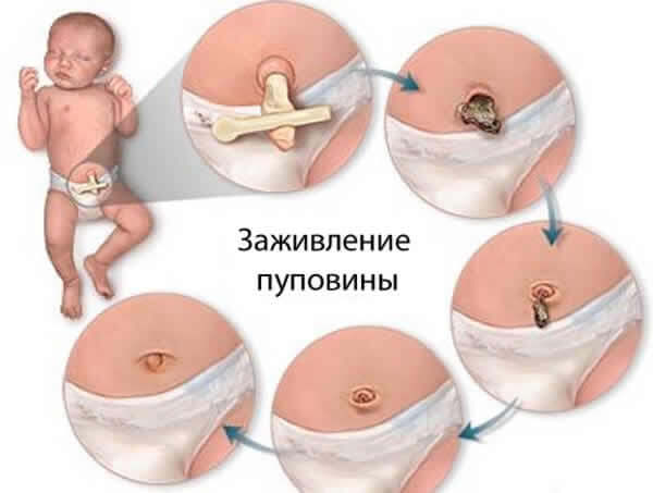 Piangendo umbilicus nei neonati: trattamento e la prevenzione onfalite