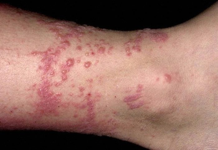 Dermatit