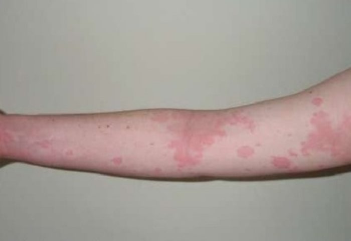 Allergy to drugs: symptoms in adults, what to do if you are allergic to drugs