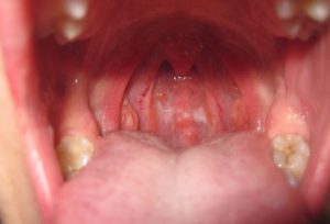 Übelkeit bei Erkältung: Warum es passiert, was zu tun ist