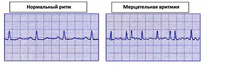 Electrocardiograma: transcripción de resultados e indicaciones para