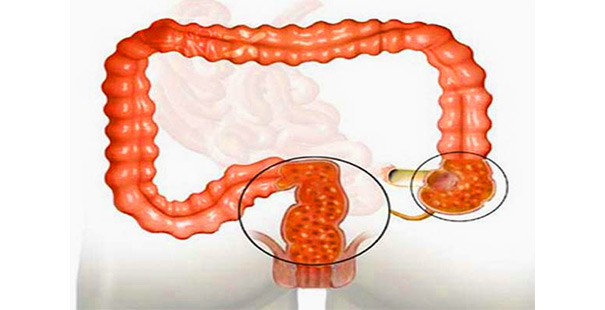 Iskæmiske Colitis: symptomer og behandling
