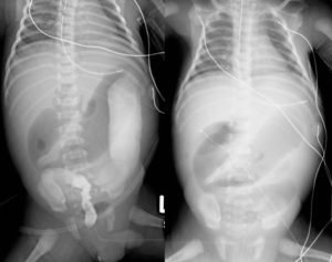 Colite intestinale: sintomi, trattamento negli adulti e nei bambini