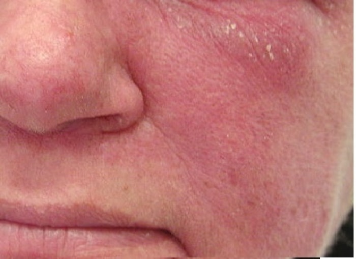 Dermatomyositis: Was ist das, Ursachen, Symptome, Behandlung, Komplikationen, Prognose