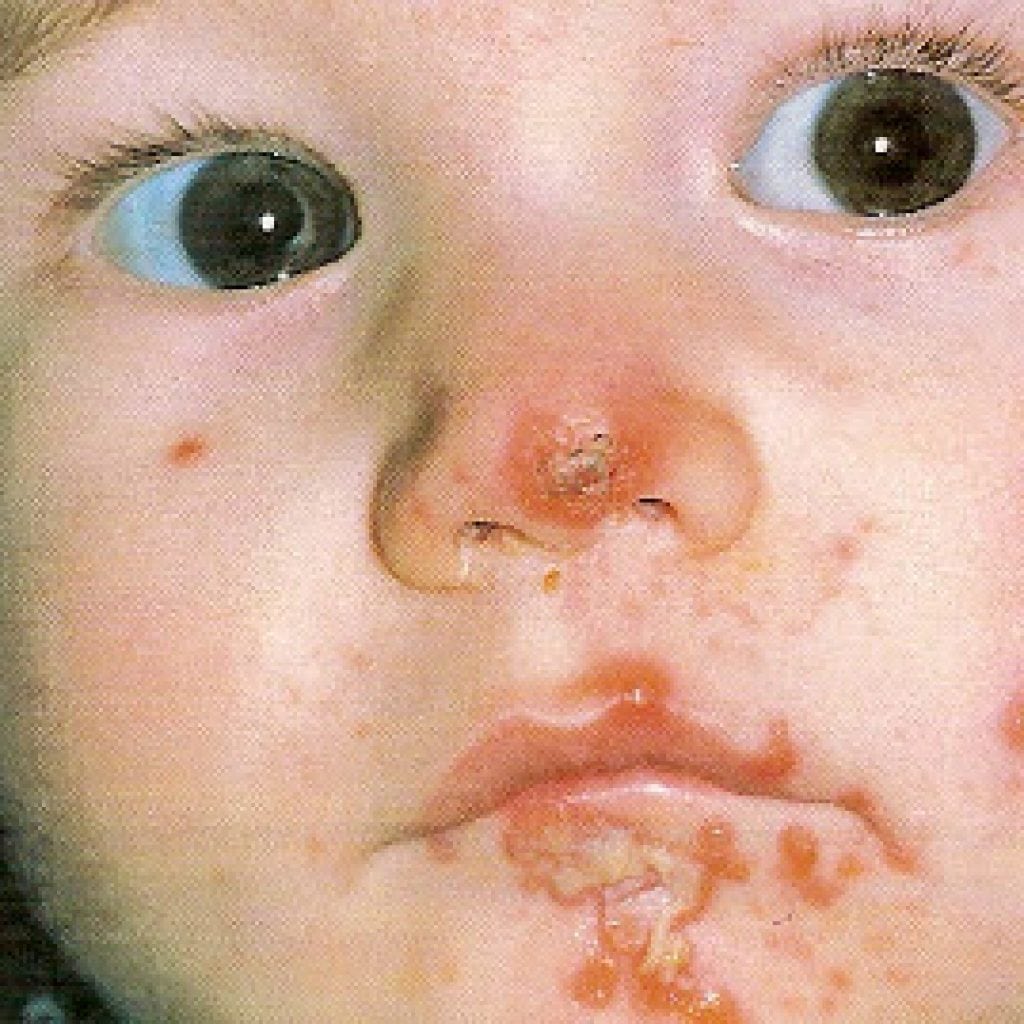 Streptoderma u dětí: fotografie, jak začíná, jak léčit