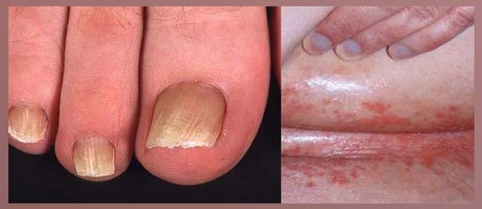 Svampskador på hud och naglar