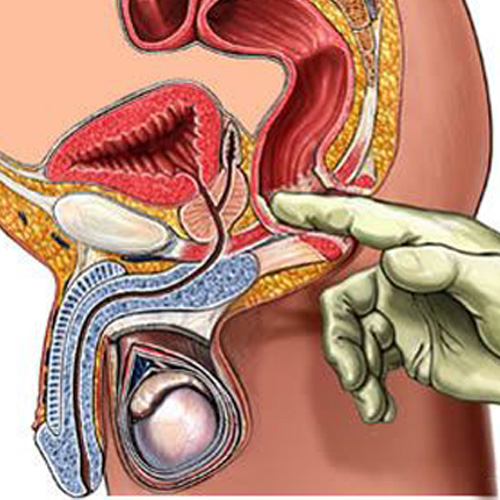Prostatitis: Ursachen, Symptome, Behandlung und Medizin der Volksmedizin