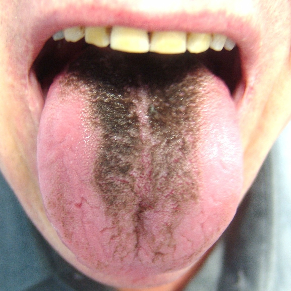 Schwarze Haarzunge: Was ist das, Symptome, Fotos, Behandlung, Prognose?