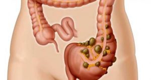 Colitis sygdom