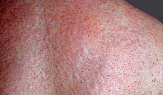 Allergy to crustaceans (shrimp, crayfish, crabs ..) symptoms, treatment