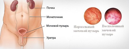 Циститис код мушкараца: симптоми и лечење код куће