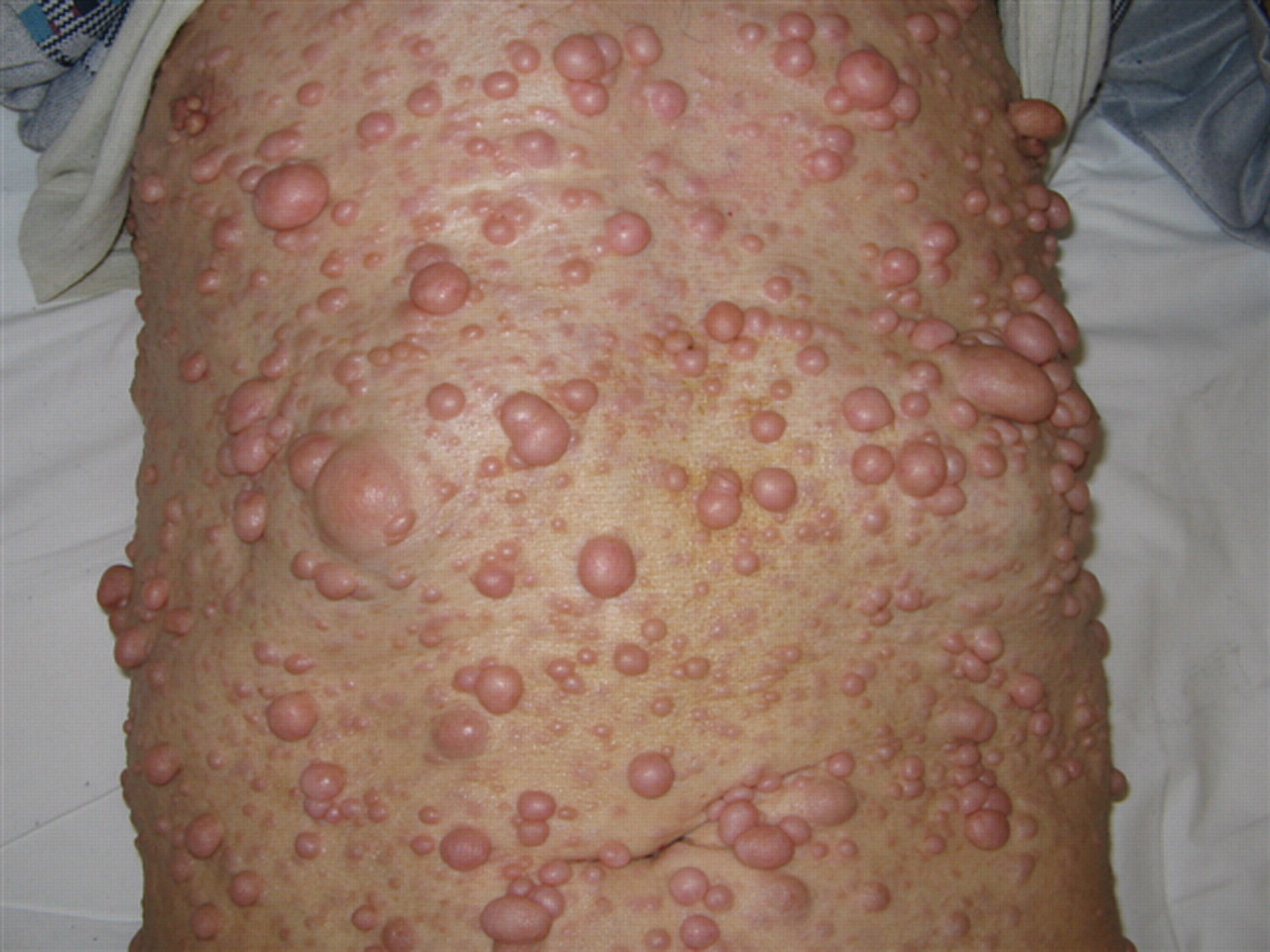 Neurofibromatose: Was ist das, Symptome, Behandlung, Prognose