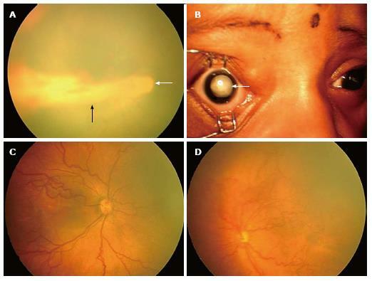 Koraszülött retinopátia: mi ez, okok, tünetek, kezelés, prognózis