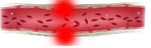 Vasculitis: tünetek és kezelés