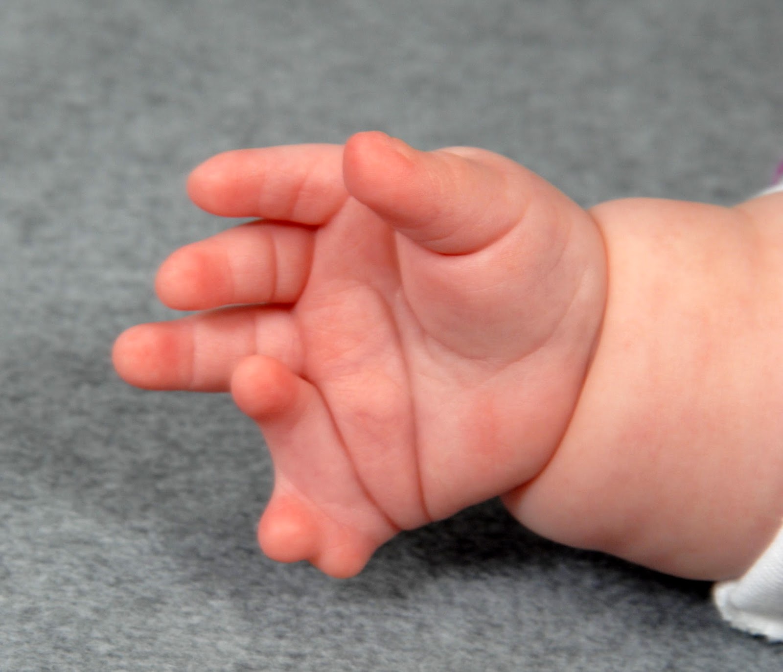Meckel's syndroom: wat is het, oorzaken, symptomen, behandeling, prognose