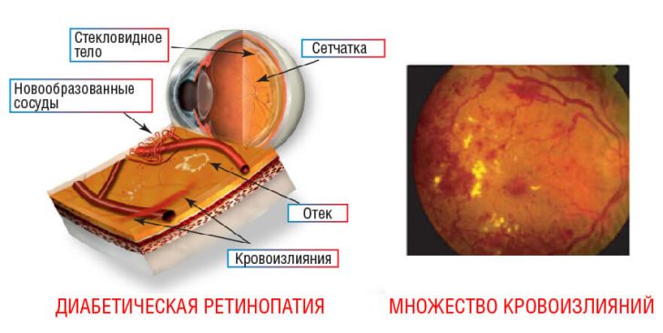 Diabetická retinopatie - oční onemocnění u diabetu