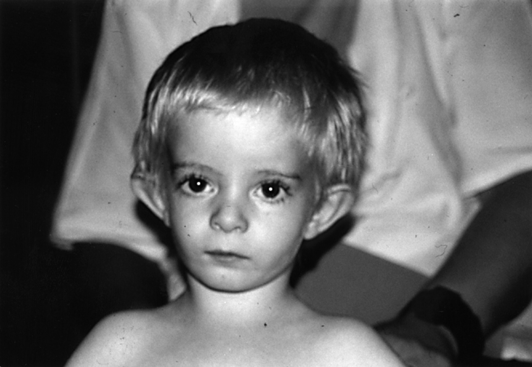 Russell-Silver-Syndrom: Was ist das, Symptome, Fotos, Behandlung, Prognose?
