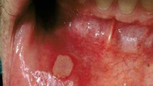 Stomatitis des Patienten