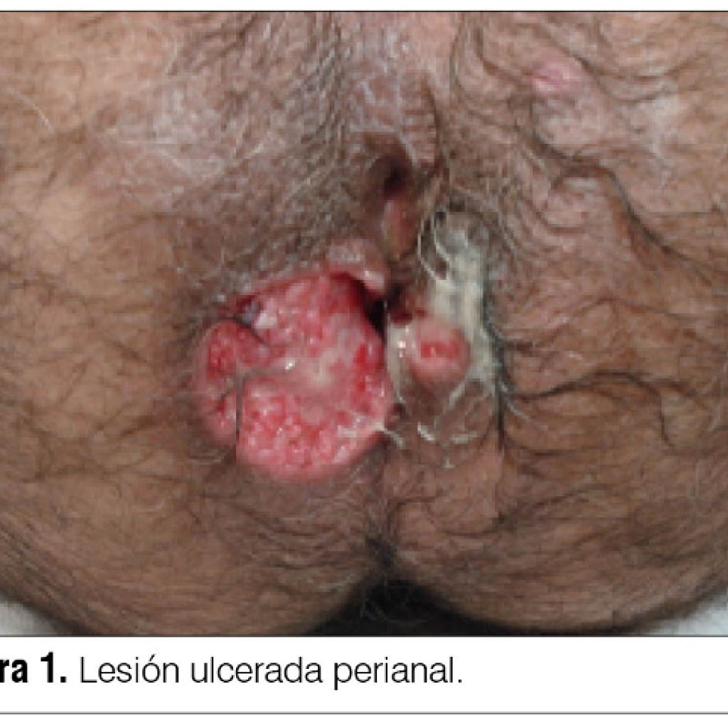 Taisnās zarnas fistula: cēloņi, simptomi, diagnostika, ārstēšana