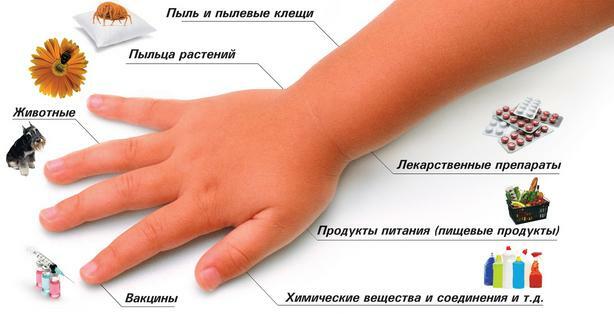 Alergia: príčiny, typy, príznaky, prvá pomoc a ošetrenie