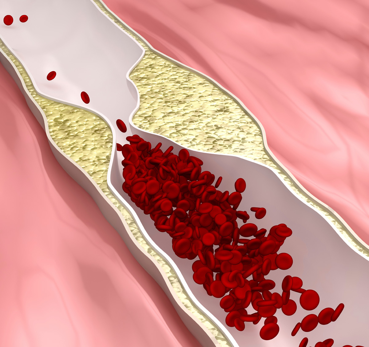 Coronary artery disease (CHD): what is it, symptoms, treatment