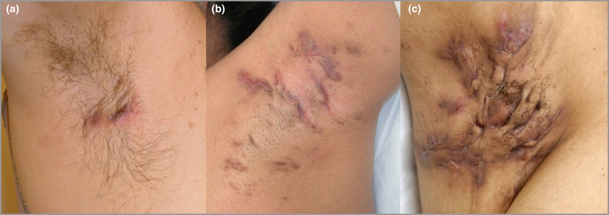 Eitrige Hydradenitis: Was ist das, Ursachen, Symptome, Behandlung, Prognose
