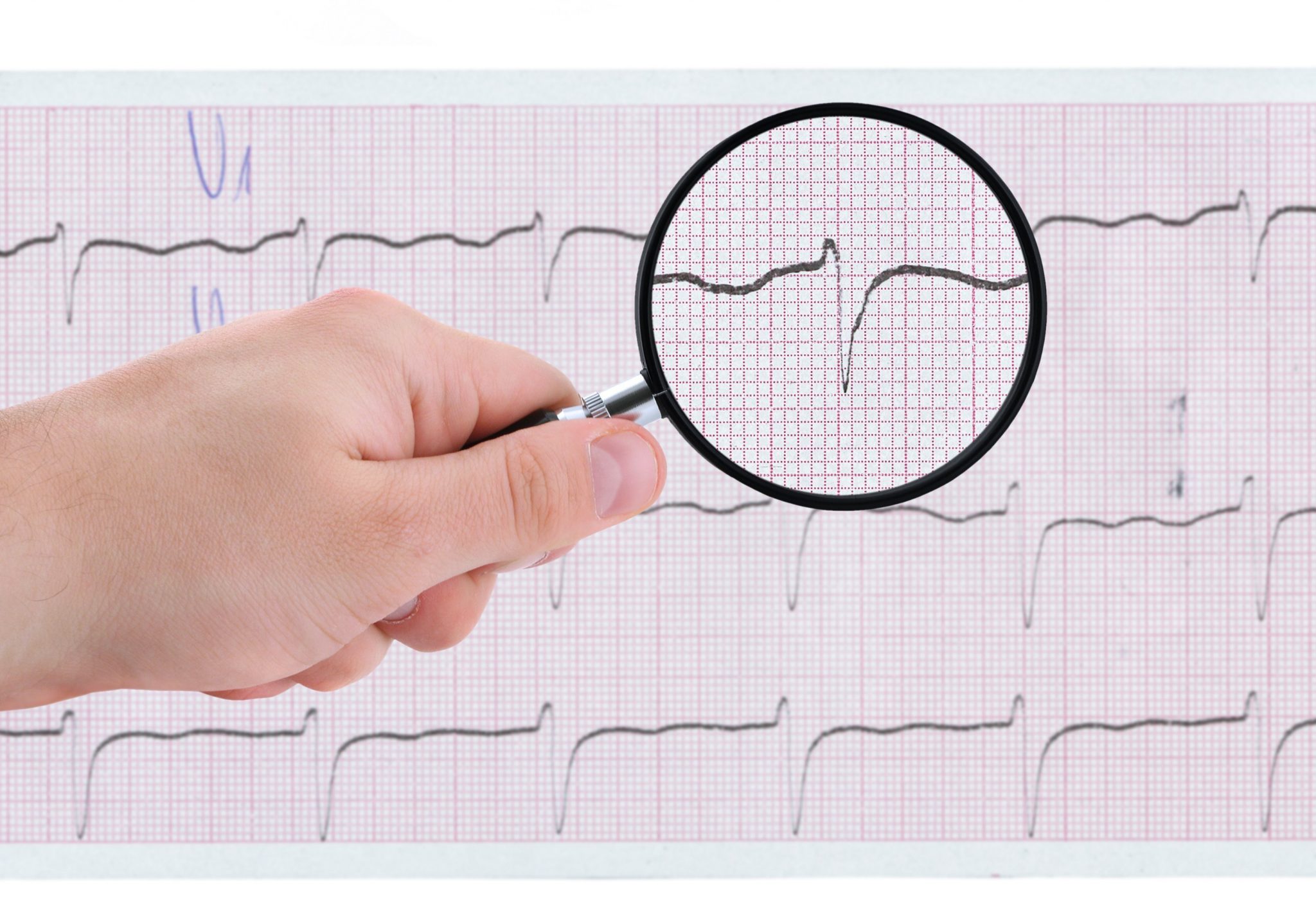 Taquicardia ventricular: que es, síntomas y tratamiento