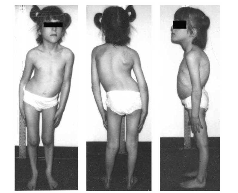 Kyphoskoliose: Was ist das, Ursachen, Symptome, Behandlung, Prognose