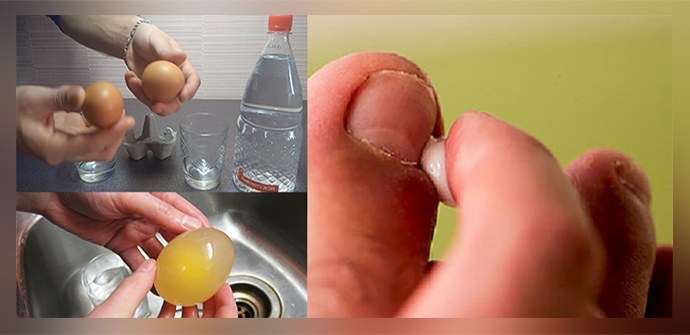 Traitement de la mycose des ongles avec du vinaigre sur les pieds, les mains: recettes efficaces, avis