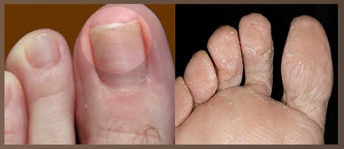 Celidonia contra hongos en las uñas de los pies: revisiones, recetas, instrucciones de uso