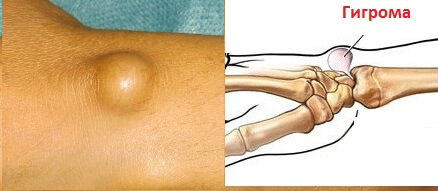 Hygroma: Symptome, Behandlung, Chirurgie