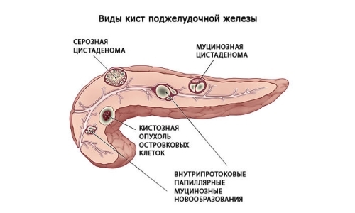 Symtom och behandling av polyp i bukspottkörteln