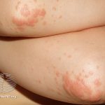 Gianotti-Crosty-Syndrom bei Kindern: Was ist das, Symptome, Behandlung, Prognose