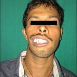 Goldenhar-Syndrom: Was ist das, Symptome, Fotos, Behandlung, Prognose?
