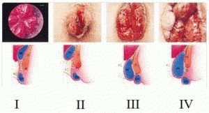 Hemorroidide astmed