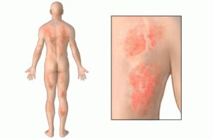 Allergie gegen ein Medikament