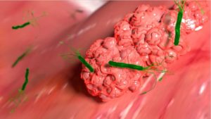 Helicobacter pylori im Magen