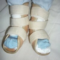 Strek av fotens ligament