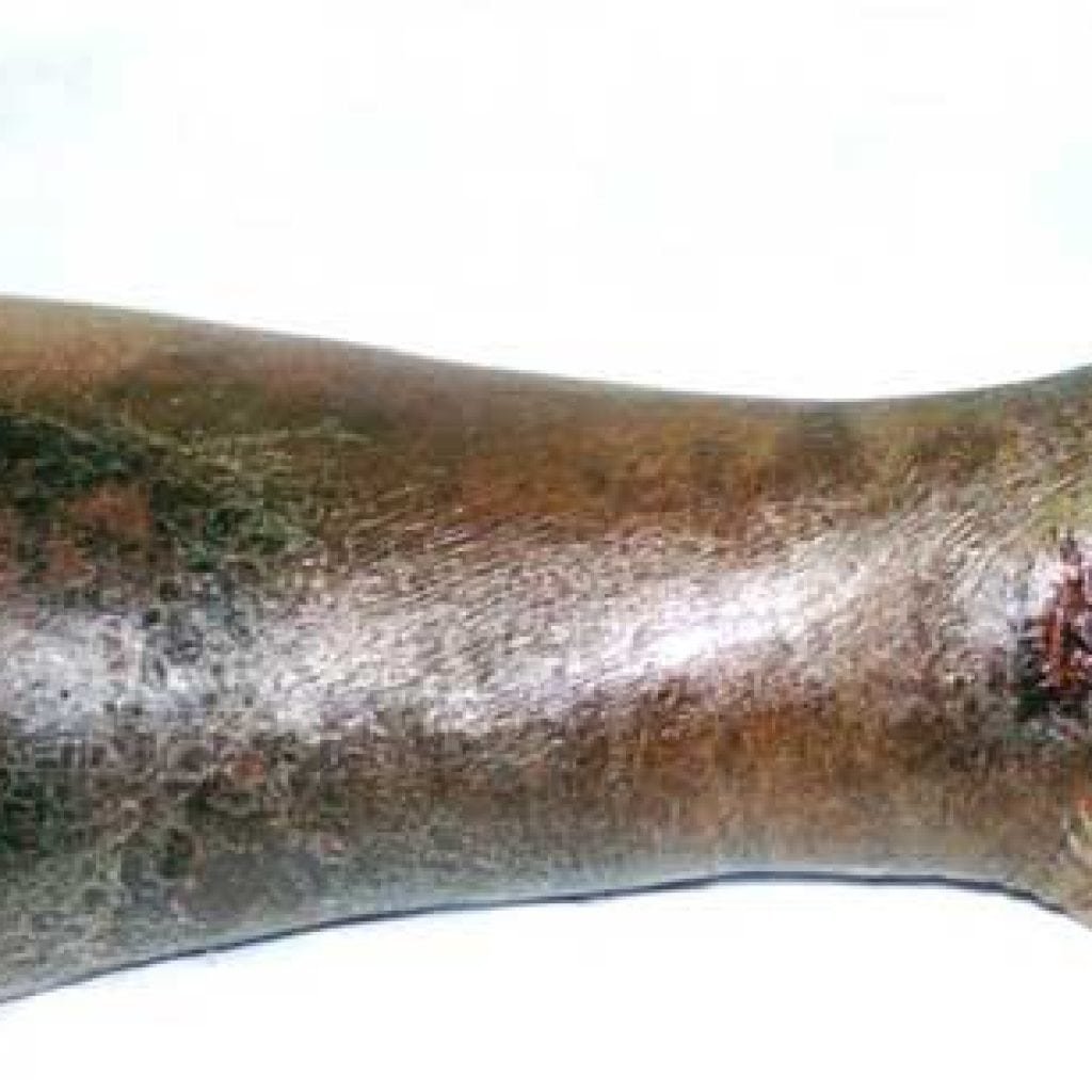 Atherosclerosis of the vessels of the lower extremities: symptoms and treatment