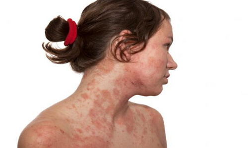 Алергија на лице