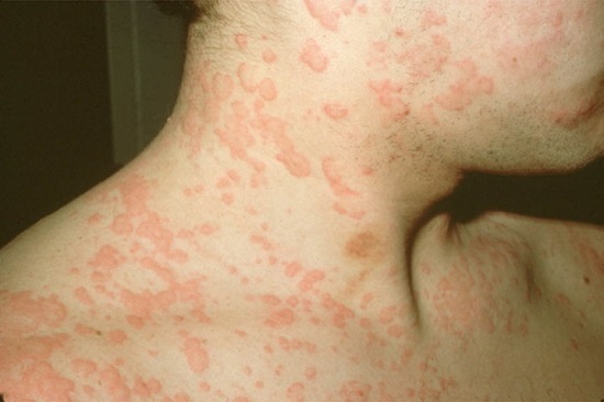 Allergia agli agrumi: sintomi e segni (foto), trattamento