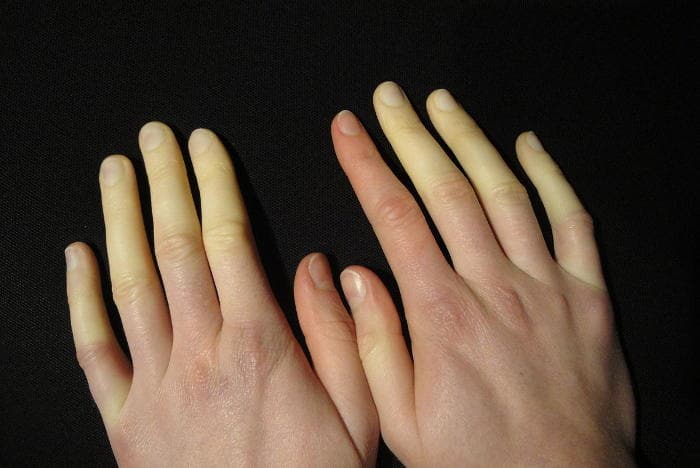 Raynaud -szindróma: mi ez, tünetek és kezelés nőknél