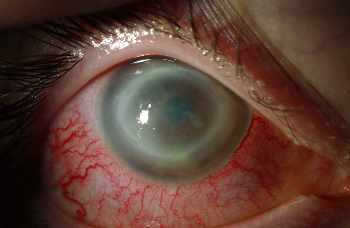 Acanthamebic keratitis: wat is het, symptomen, behandeling, prognose, complicaties