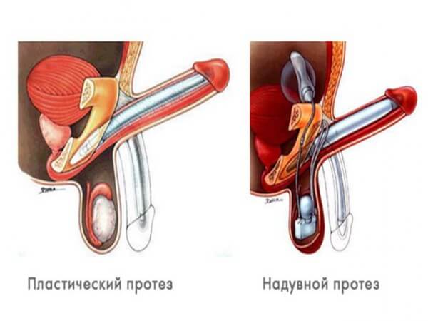 Oleogranuloma of the penis: causes, symptoms and treatment