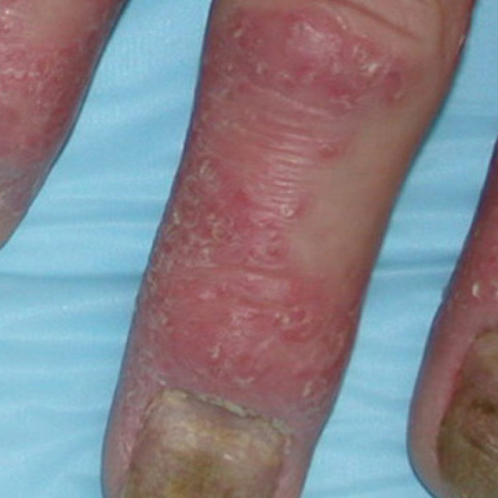 Psoriatic arthritis: tünetek, kezelés, fotó