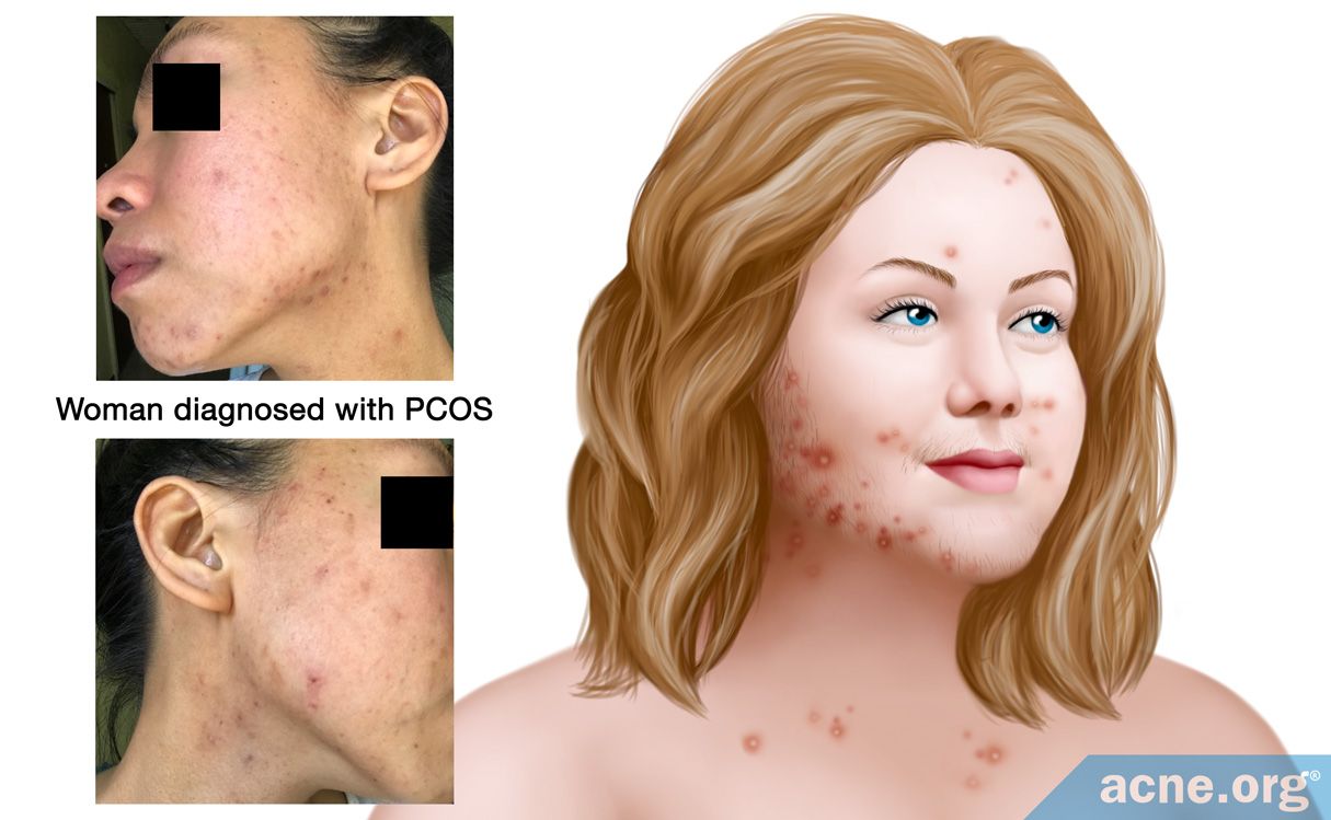 Syndrom der polyzystischen Ovarien: Was ist das, Symptome, Behandlung, Prognose?