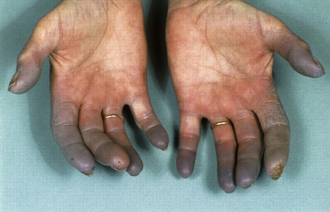 Buergerova bolest (tromboangiitis obliterans): uzroci, simptomi, liječenje