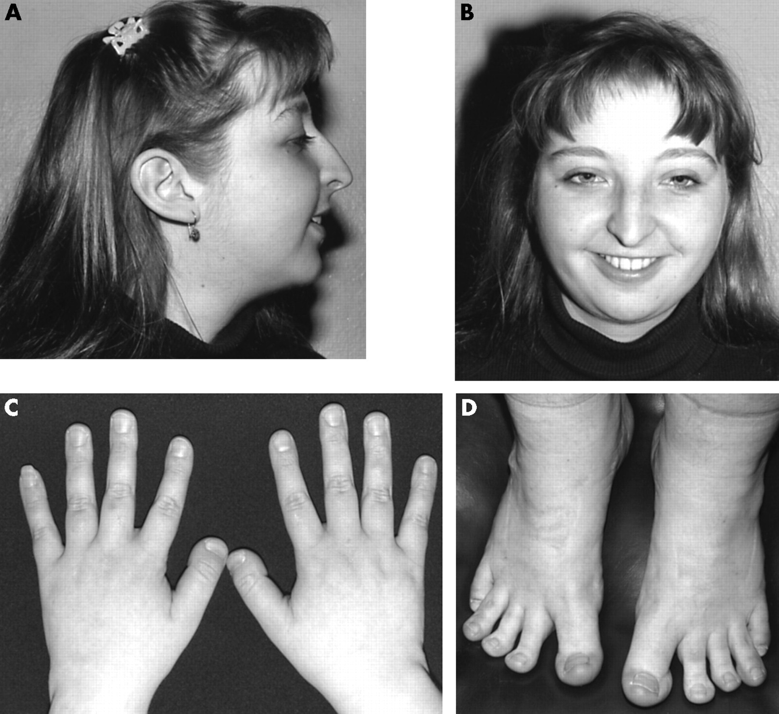 Rubinstein-Teibi-Syndrom: Was ist das, Ursachen, Symptome, Behandlung, Prognose